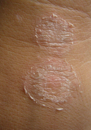 體股癬初期現象