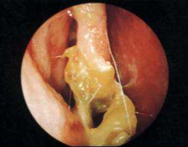 重度細菌性鼻腔慢性鼻炎