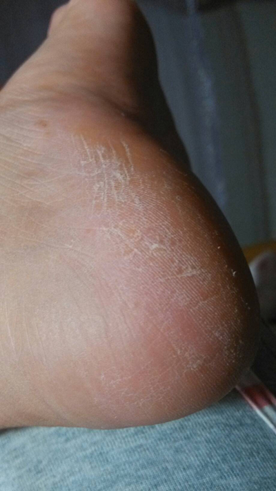 腳底乾裂 (7) 