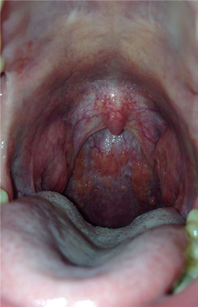 喉部淋巴濾泡增生 (45) 