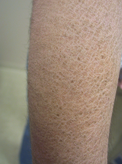 小腿皮膚像魚鱗 (52) 