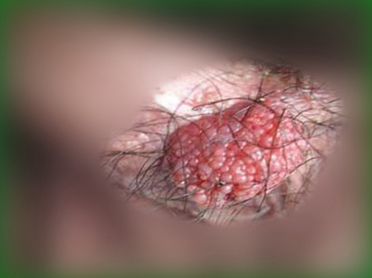 男性尖銳溼疣照片 (47) 