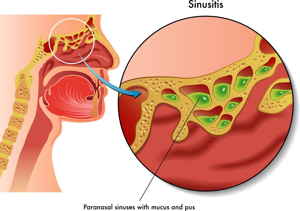 慢性鼻炎的成因漫畫 