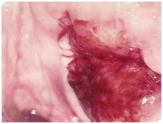 淋病的症狀 (40) 