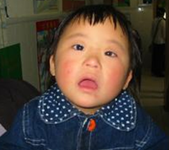 先天愚型通貫手