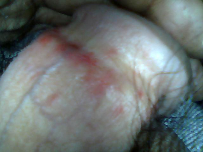 包皮龜頭炎系列