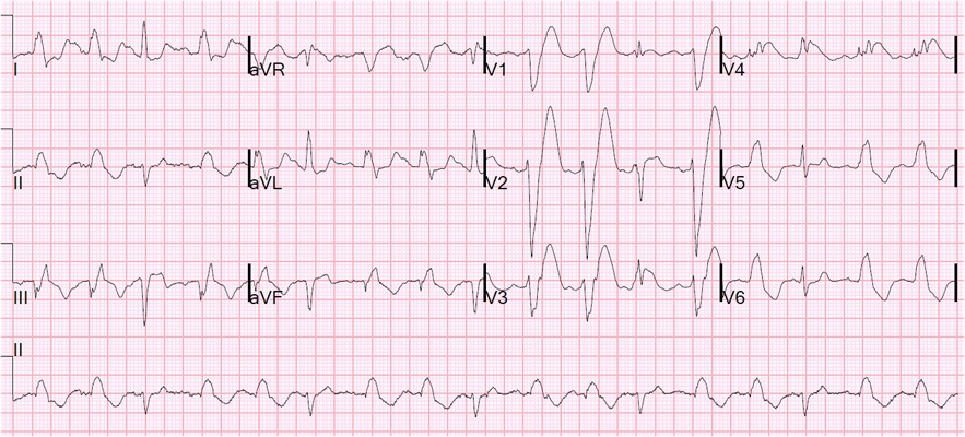 房顫心電圖特點 (64) 