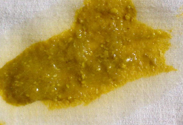 新生兒消化不良大便圖 (5) 