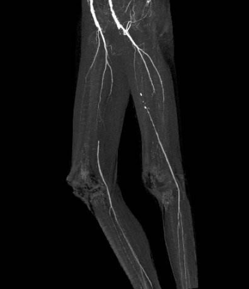 脈管炎早期症狀