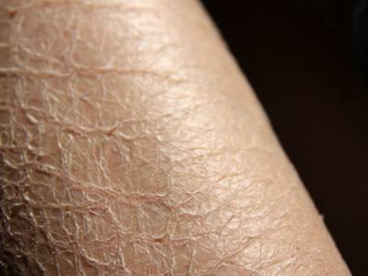 小腿皮膚像魚鱗 (57) 