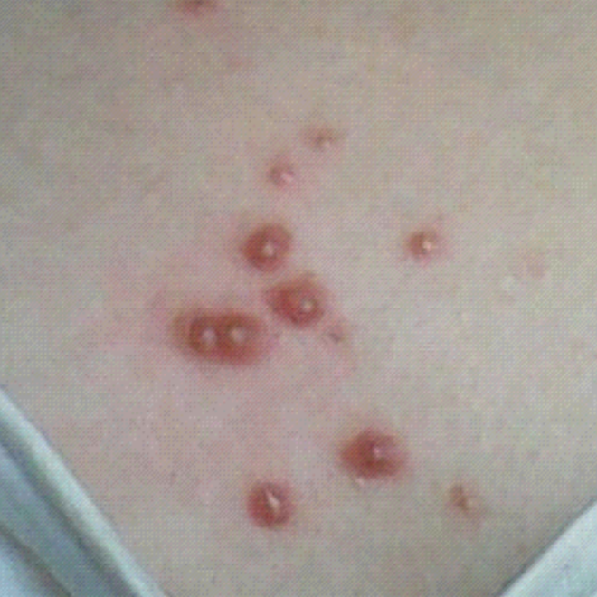 臉上的皮囊炎怎麼治療 