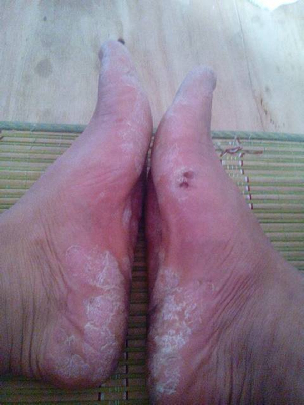 特別嚴重的腳蘚