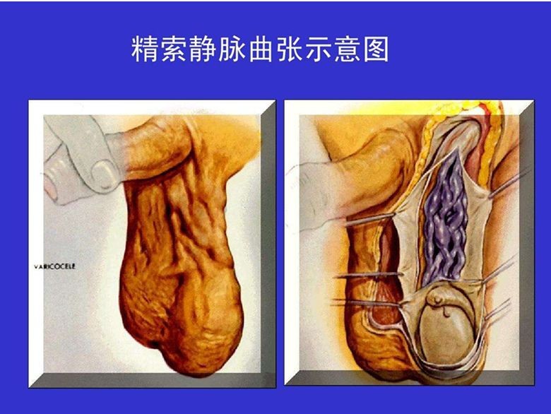精索曲張睪丸下墜時