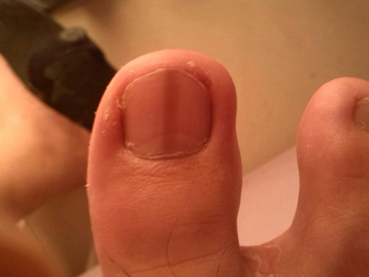 手指甲上有豎紋圖解 (7) 