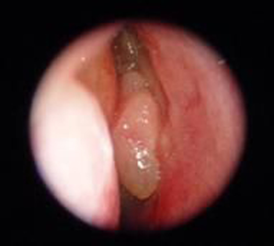 息肉狀的慢性鼻炎