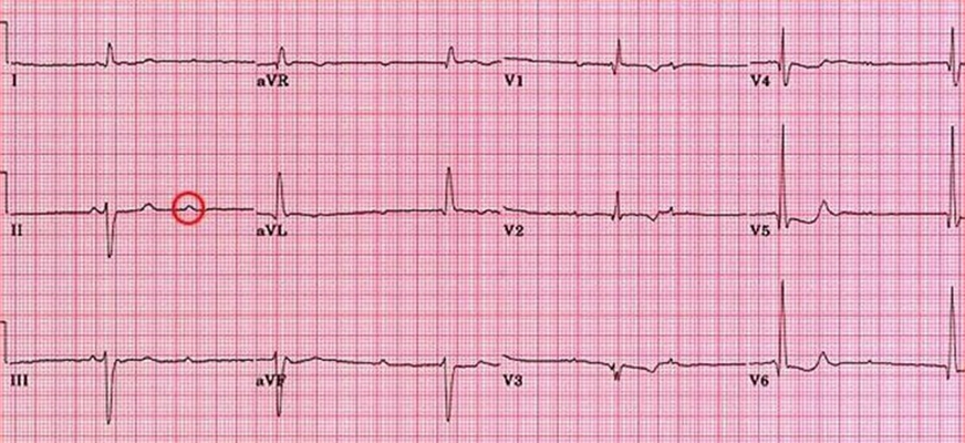 頻發房性早搏 (42) 