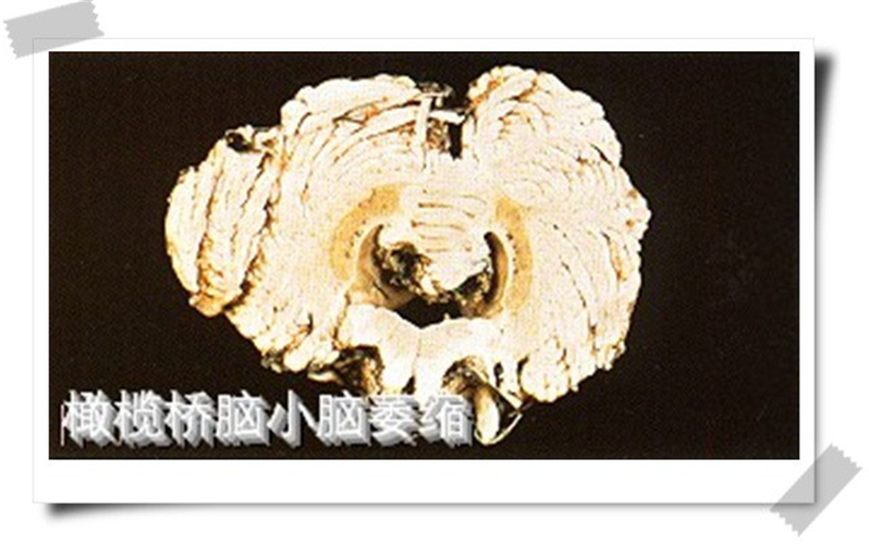 橄欖橋腦小腦腦萎縮標本
