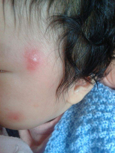 血熱的症狀痘痘