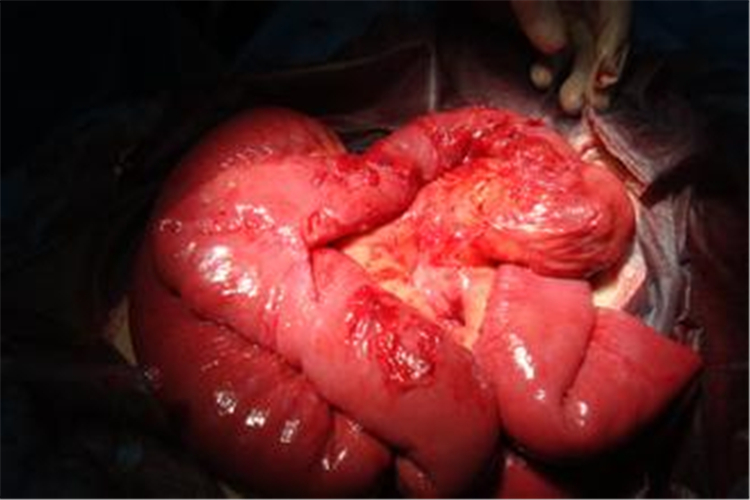 手術引發腸粘連高清