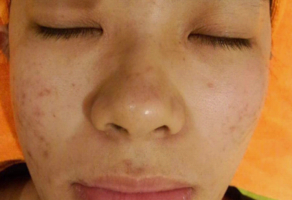 臉上皮囊炎怎麼辦 