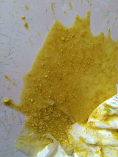 新生兒腹瀉大便