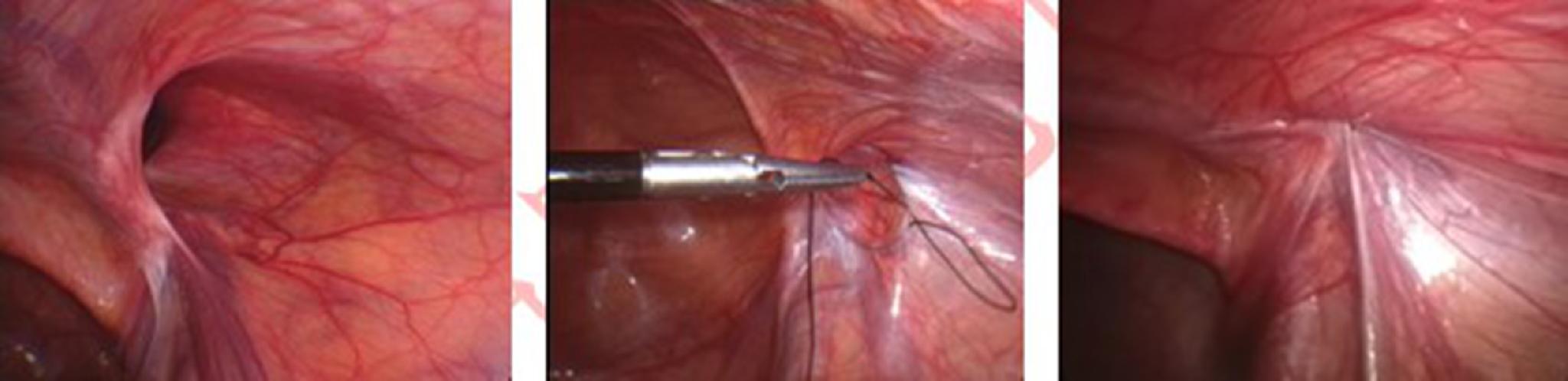 腹壁切口疝白線疝