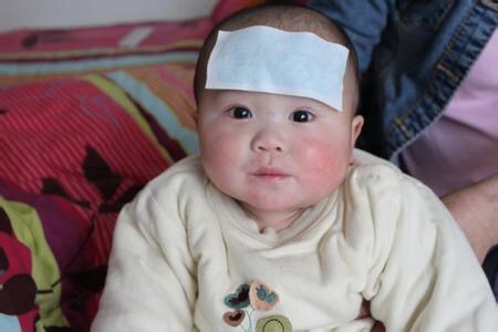 小兒急疹的症狀 (33) 