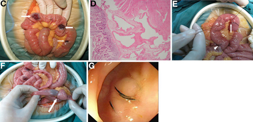 結腸癌症狀 (39) 