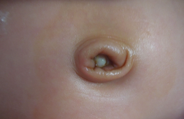 寶寶臍帶脫落後