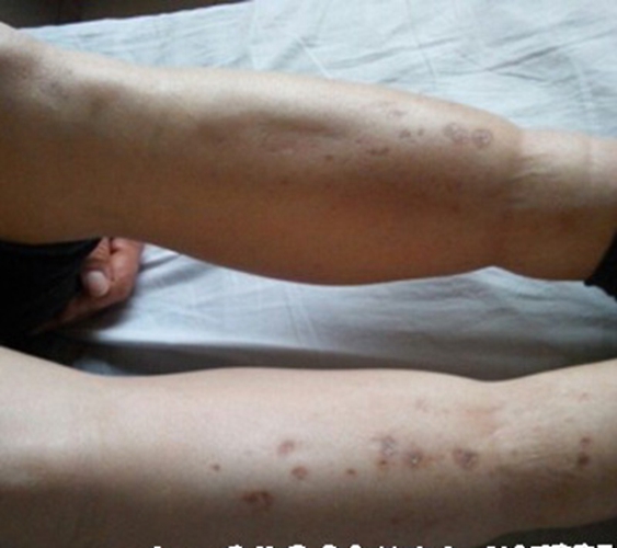 糖尿病腎病是什麼