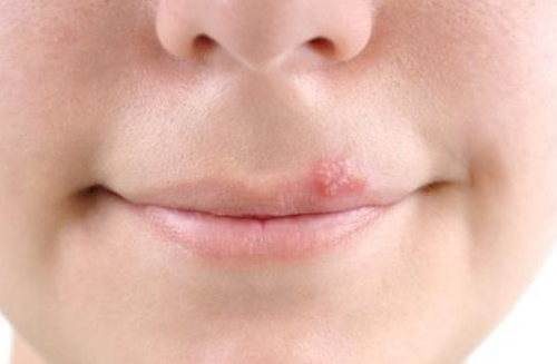 嘴唇潰瘍