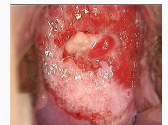 淋病的症狀 (47) 