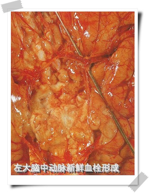 血栓性腦梗塞