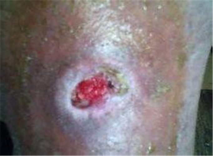 白塞病嚴重症狀