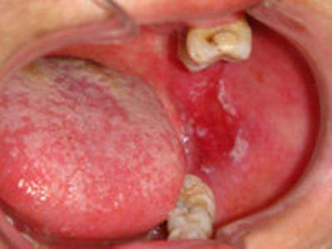 治療扁平苔蘚的藥膏 