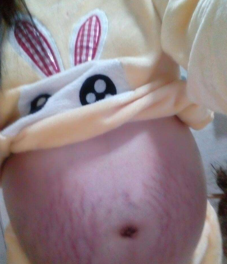 懷孕後期妊辰紋