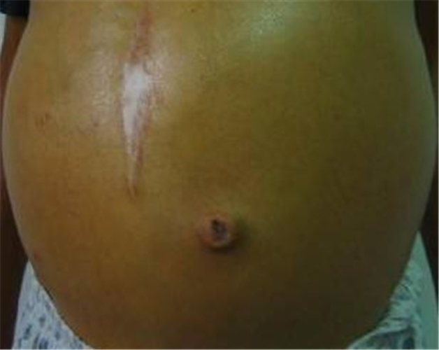 酒精肝腹部症狀