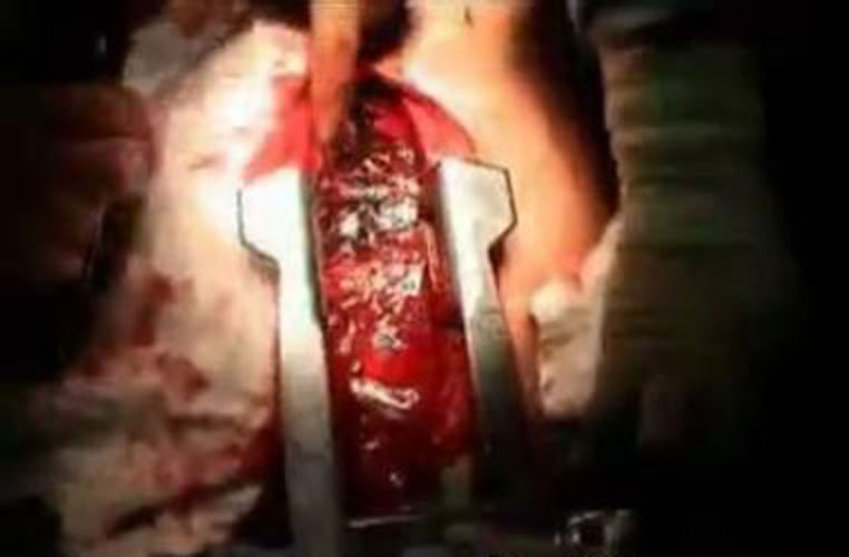 手術中的肋骨骨折