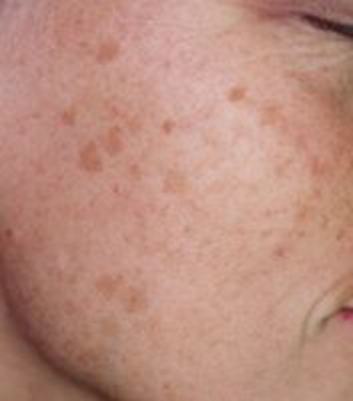 如何擦除老年斑