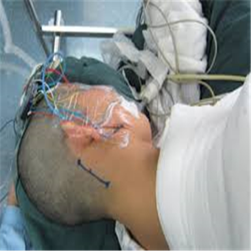 微血管減壓術治療面肌痙攣