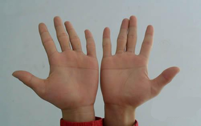 先天愚型兒掌紋