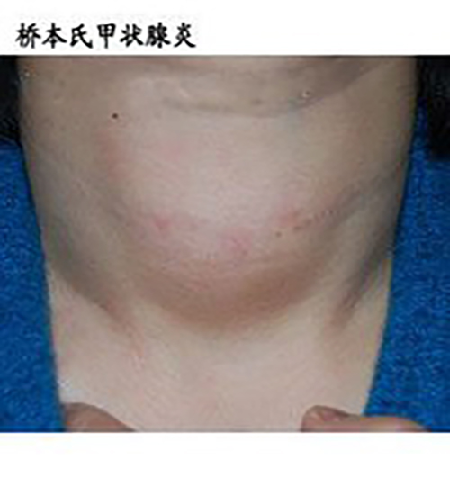 橋本氏甲狀腺炎的症狀