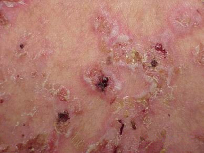 大皰性皮膚病落葉狀天皰瘡局部潰爛