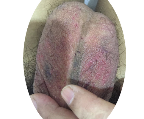 精索曲張睪丸下墜時