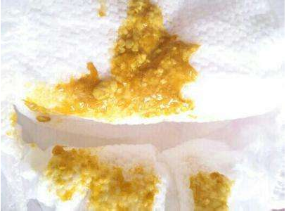 新生兒消化不良大便圖 (9) 