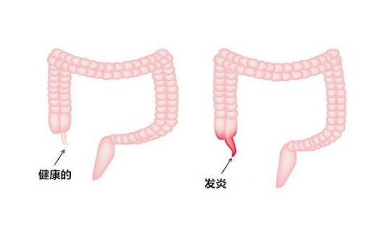 闌尾炎的症狀表現 (59) 