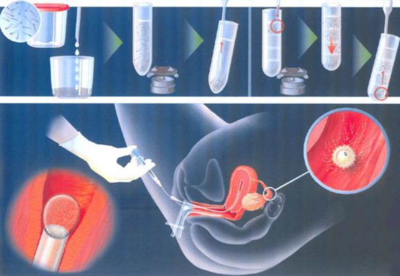 人工受完孕的過程 (47) 