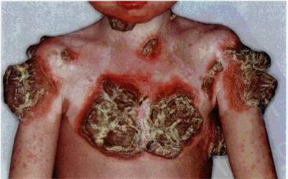 胸部皮膚念珠菌病