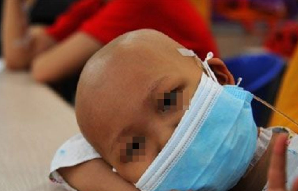 非霍奇金淋巴瘤症狀 