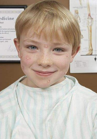 長水痘的症狀 (62) 